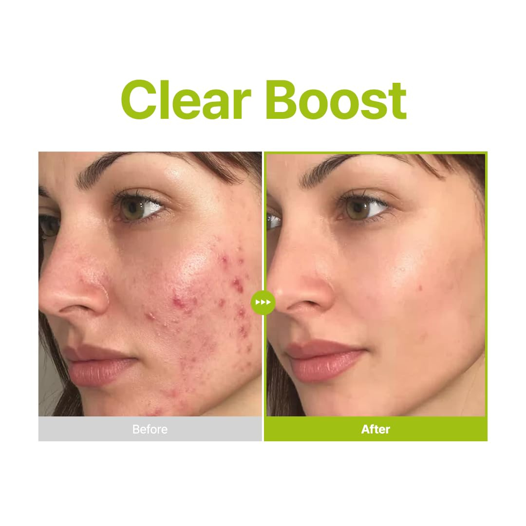 PURITO Azelaic Acid 10% + Kojic Acid + Tea Tree Facial Serum | for Blemish-Prone, Oily & Sensitive Skin | Redness Soothing | Korean Skincare, 30mL Purito Seoul