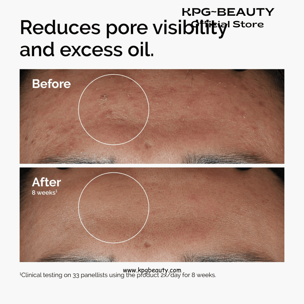 The Ordinary Niacinamide 10% + Zinc 1%, Brightening & Smoothing Serum for Blemish - Prone SkinThe Ordinary