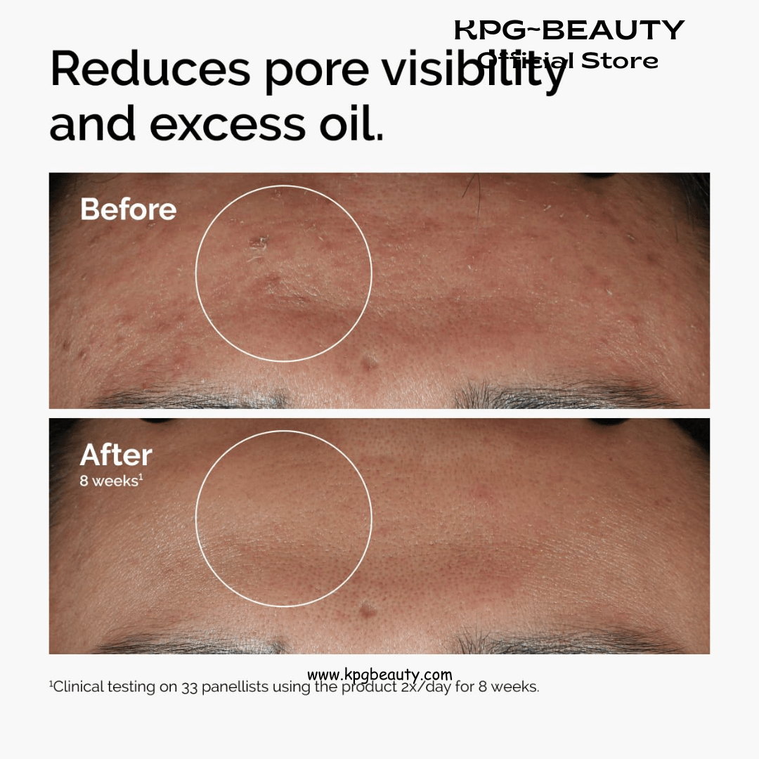 The Ordinary Niacinamide 10% + Zinc 1%, Brightening & Smoothing Serum for Blemish - Prone SkinThe Ordinary